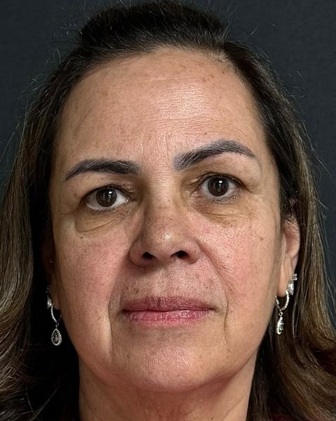Antes dos fios de PDO: paciente da Dra. Stephanie Mansan, no Tatuapé