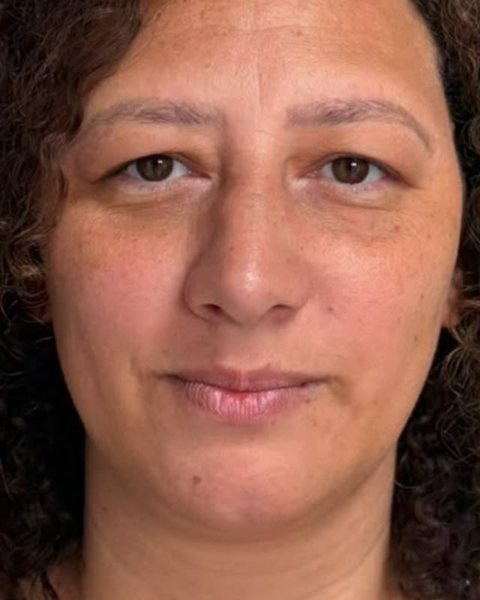 Antes dos fios de PDO: paciente da Dra. Stephanie Mansan, no Tatuapé