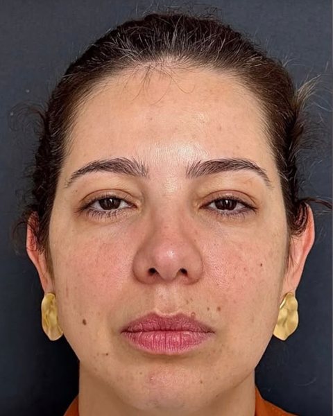 Antes dos fios de PDO: paciente da Dra. Stephanie Mansan, no Tatuapé