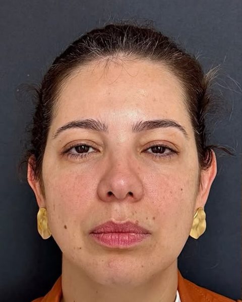 Antes dos fios de PDO: paciente da Dra. Stephanie Mansan, no Tatuapé