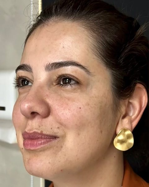 De perfil, antes dos fios de PDO: paciente da Dra. Stephanie Mansan, no Tatuapé